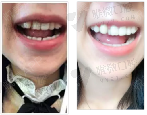 美容冠修复牙齿怎么样（牙齿美容冠是什么样子）(图1)